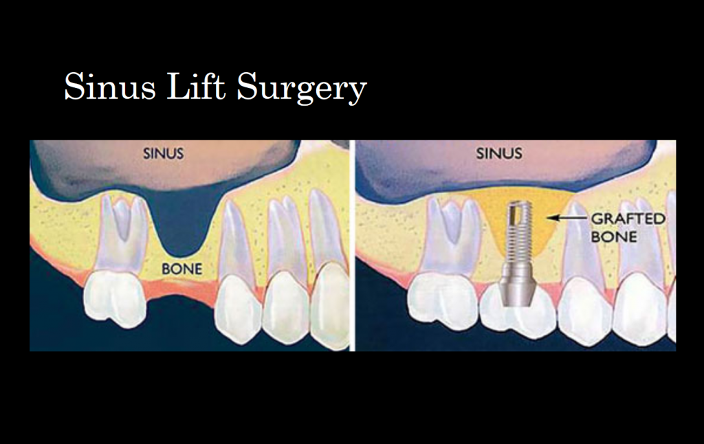 Sinus Lift Surgery Plano, TX