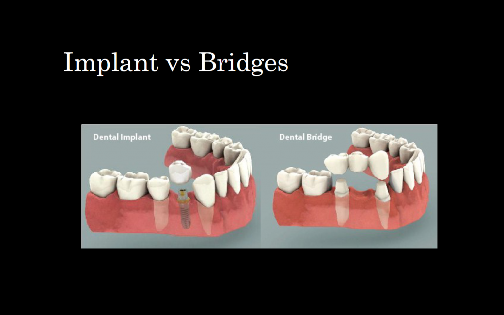 Dental Implants Vs Bridges