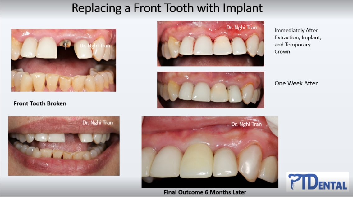 Implant - Broken Front Tooth Replacement