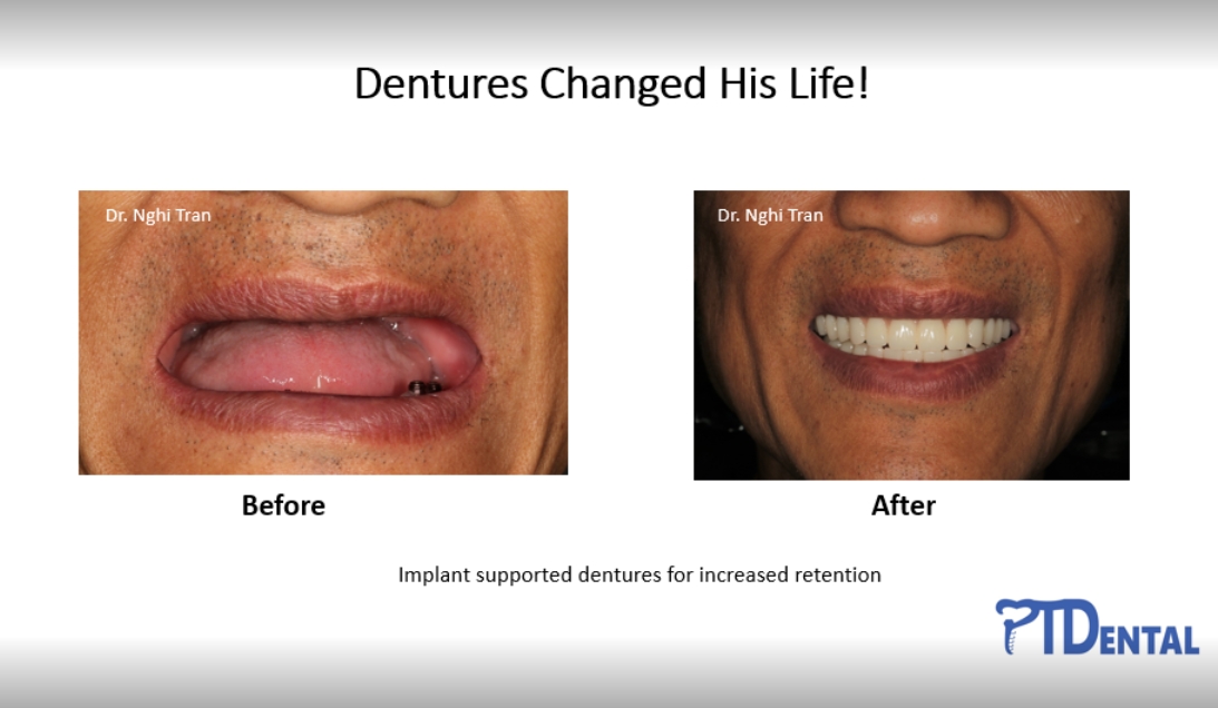 Dentures Before & After Results