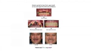 implant Dentistry Cases